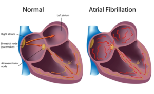 Inilah Beberapa Jenis dari Komplikasi Atrial fibrillation